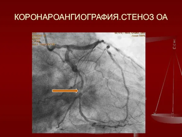 КОРОНАРОАНГИОГРАФИЯ.СТЕНОЗ ОА