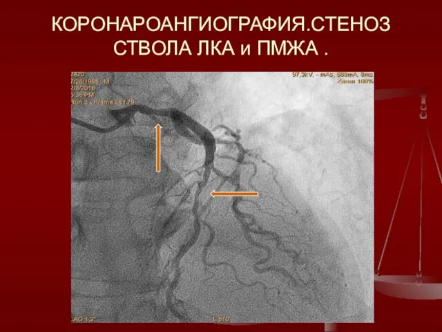 КОРОНАРОАНГИОГРАФИЯ.СТЕНОЗ СТВОЛА ЛКА и ПМЖА .