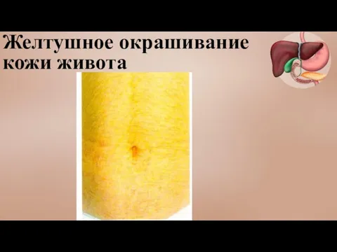 Желтушное окрашивание кожи живота