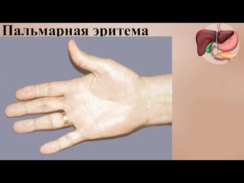 Пальмарная эритема