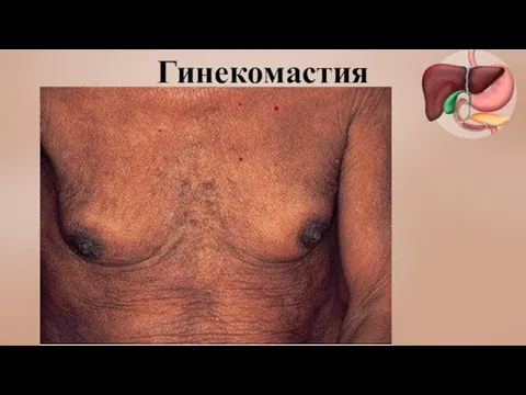 Гинекомастия