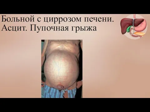 Больной с циррозом печени. Асцит. Пупочная грыжа