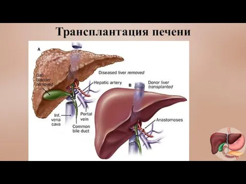 Трансплантация печени Трансплантация печени