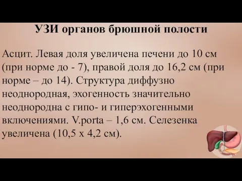 УЗИ органов брюшной полости Асцит. Левая доля увеличена печени до 10