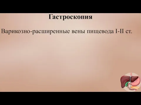 Гастроскопия Варикозно-расширенные вены пищевода I-II ст.