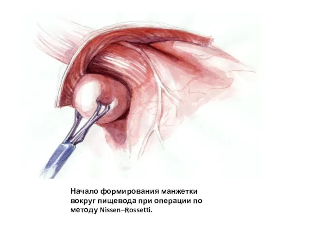 Начало формирования манжетки вокруг пищевода при операции по методу Nissen–Rossetti.