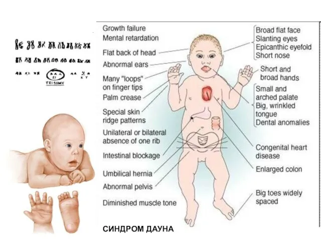 СИНДРОМ ДАУНА