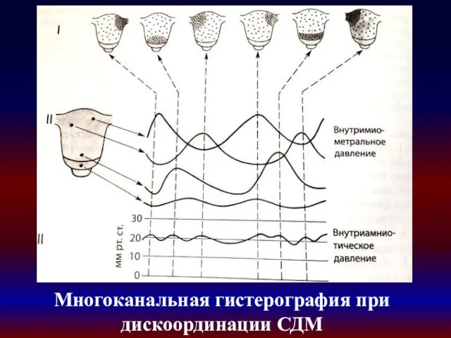 Многоканальная гистерография при дискоординации СДМ