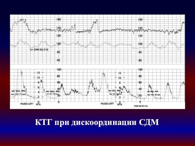 КТГ при дискоординации СДМ