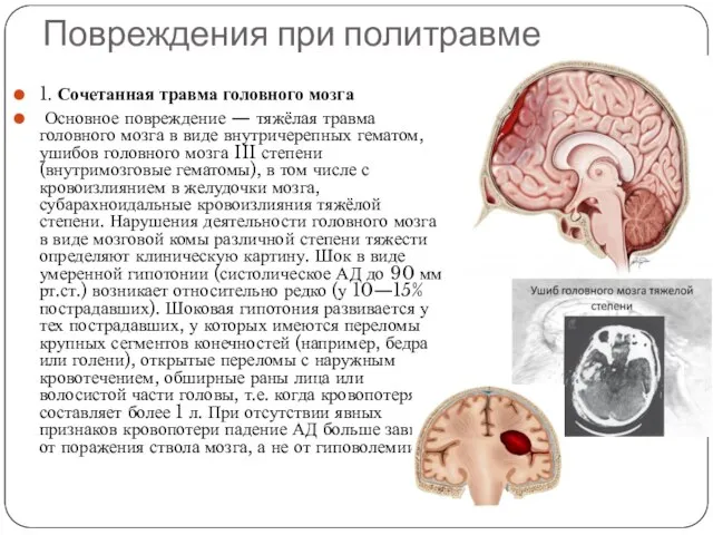 Повреждения при политравме 1. Сочетанная травма головного мозга Основное повреждение —