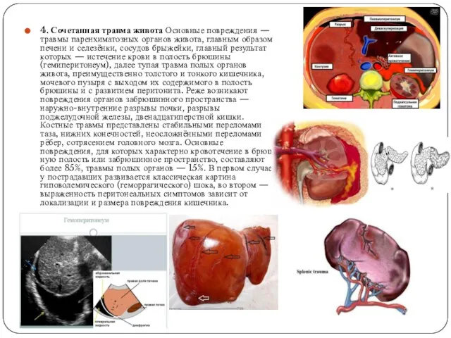 4. Сочетанная травма живота Основные повреждения — травмы паренхиматозных органов живота,