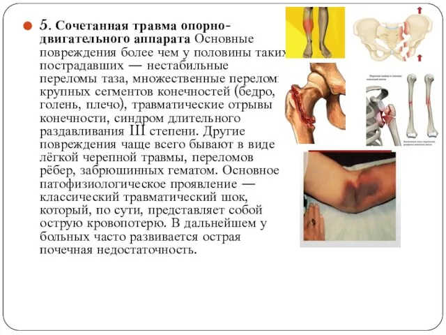 5. Сочетанная травма опорно-двигательного аппарата Основные повреждения более чем у половины