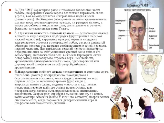 4. Для ЧМТ характерны раны и гематомы волосистой части головы, де