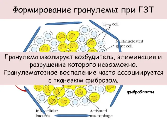 Формирование гранулемы при ГЗТ TNF-α IL-1β фибробласты Гранулема изолирует возбудитель, элиминация