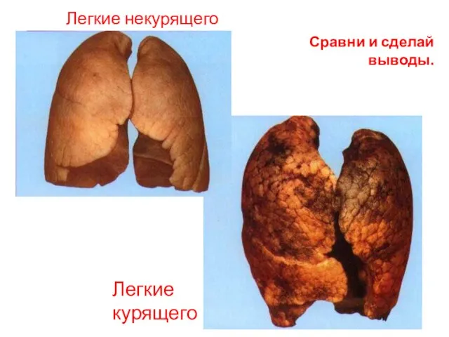 Сравни и сделай выводы. Легкие некурящего Легкие курящего