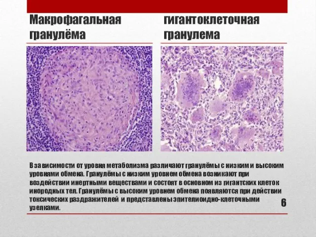 В зависимости от уровня метаболизма различают гранулёмы с низким и высоким