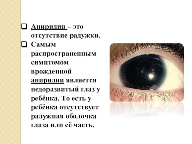 Аниридия – это отсутствие радужки. Самым распространенным симптомом врожденной аниридии является