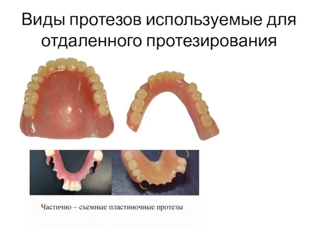 Виды протезов используемые для отдаленного протезирования