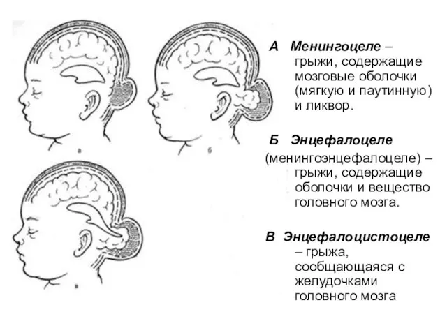 А Менингоцеле – грыжи, содержащие мозговые оболочки (мягкую и паутинную) и