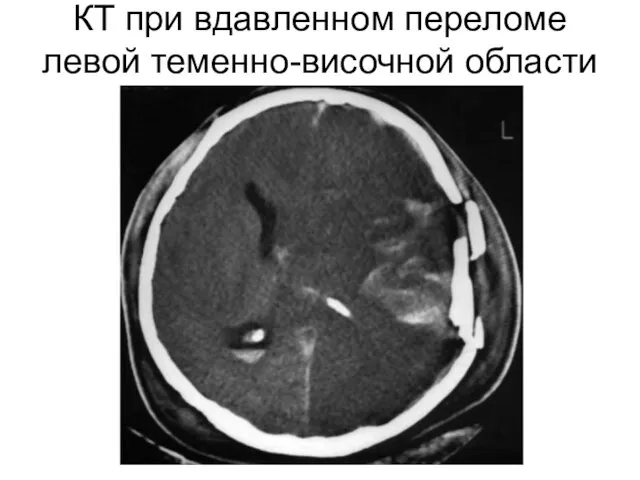 КТ при вдавленном переломе левой теменно-височной области