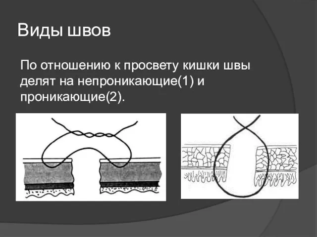 Виды швов По отношению к просвету кишки швы делят на непроникающие(1) и проникающие(2).