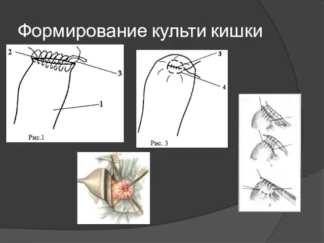 Формирование культи кишки