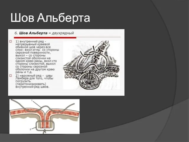 Шов Альберта