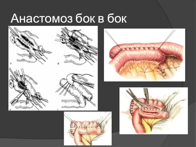 Анастомоз бок в бок