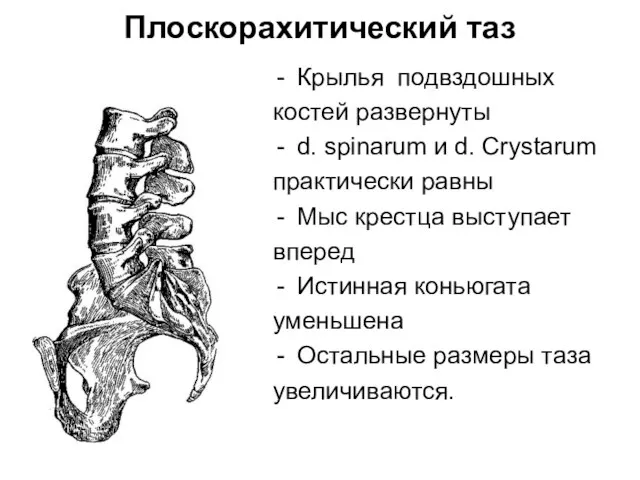 Плоскорахитический таз Крылья подвздошных костей развернуты d. spinarum и d. Crystarum