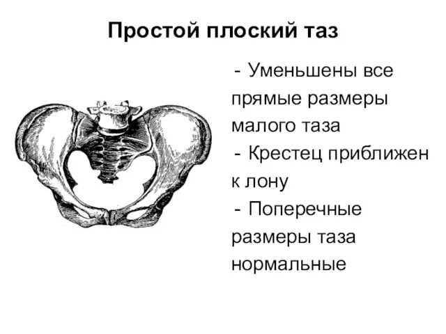 Простой плоский таз Уменьшены все прямые размеры малого таза Крестец приближен