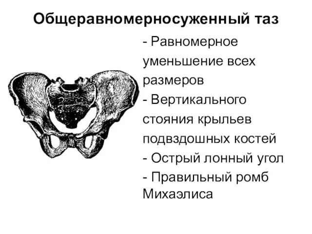 Общеравномерносуженный таз - Равномерное уменьшение всех размеров - Вертикального стояния крыльев