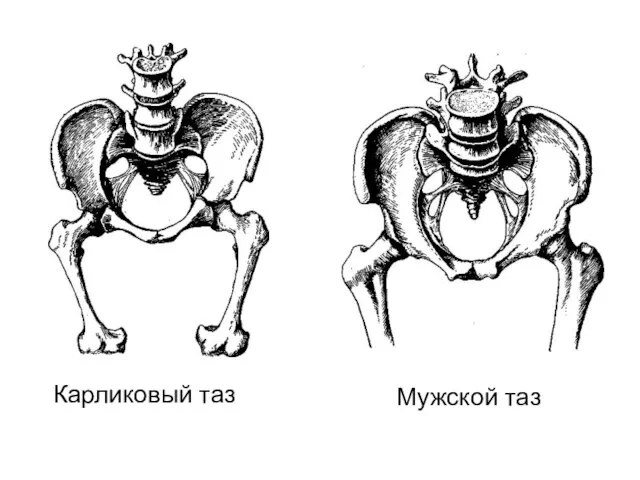 Карликовый таз Мужской таз