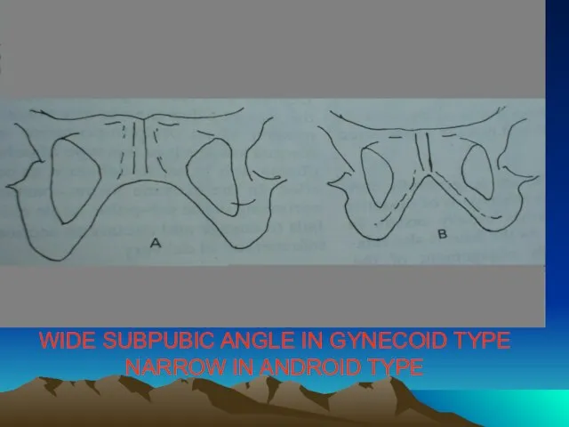 WIDE SUBPUBIC ANGLE IN GYNECOID TYPE NARROW IN ANDROID TYPE