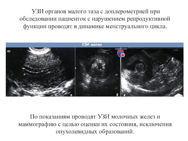 УЗИ органов малого таза с доплерометрией при обследовании пациенток с нарушением