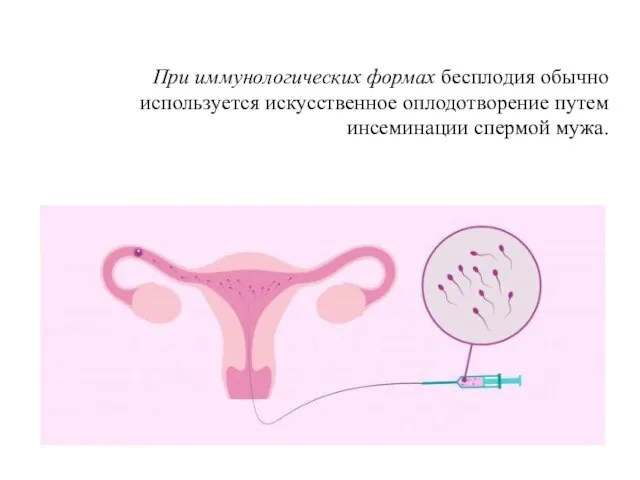 При иммунологических формах бесплодия обычно используется искусственное оплодотворение путем инсеминации спермой мужа.