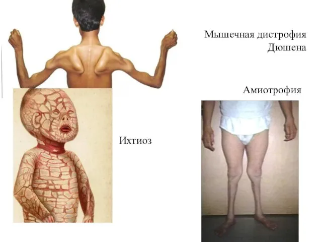 Мышечная дистрофия Дюшена Ихтиоз Амиотрофия