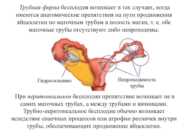 Трубная форма бесплодия возникает в тех случаях, когда имеются анатомические препятствия