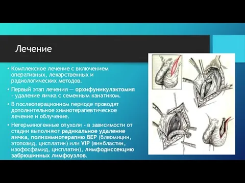 Лечение Комплексное лечение с включением оперативных, лекарственных и радиологических методов. Первый