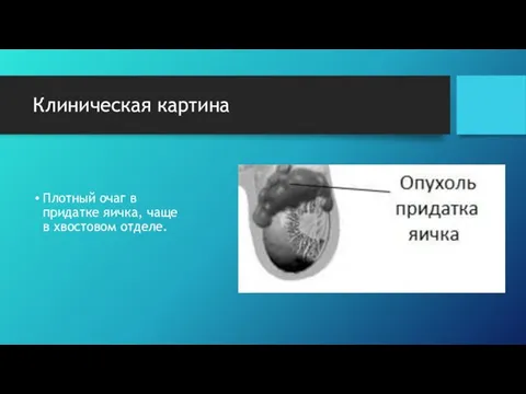 Клиническая картина Плотный очаг в придатке яичка, чаще в хвостовом отделе.