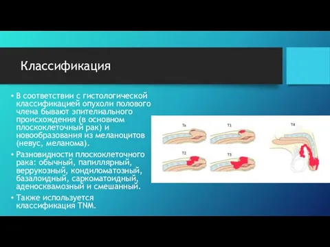 Классификация В соответствии с гистологической классификацией опухоли полового члена бывают эпителиального