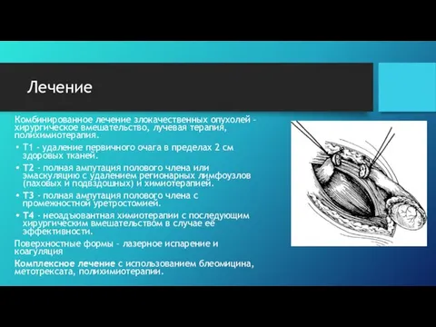 Лечение Комбинированное лечение злокачественных опухолей – хирургическое вмешательство, лучевая терапия, полихимиотерапия.