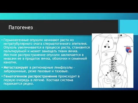 Патогенез Герминогенные опухоли начинают расти из интратубулярного очага сперматогенного эпителия. Опухоль