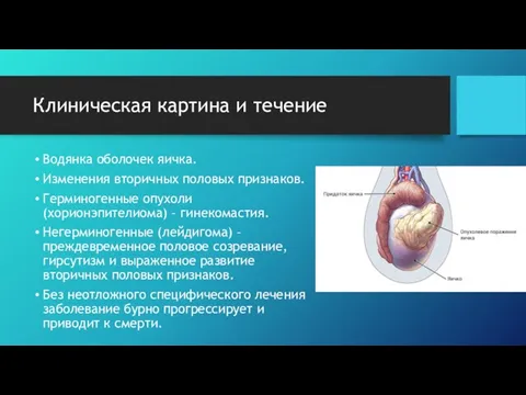 Клиническая картина и течение Водянка оболочек яичка. Изменения вторичных половых признаков.