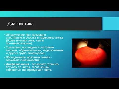 Диагностика Обнаружение при пальпации уплотненного участка в паренхиме яичка (более плотная