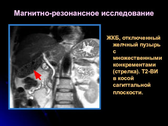 Магнитно-резонансное исследование ЖКБ, отключенный желчный пузырь с множественными конкрементами (стрелка). Т2-ВИ в косой сагиттальной плоскости.