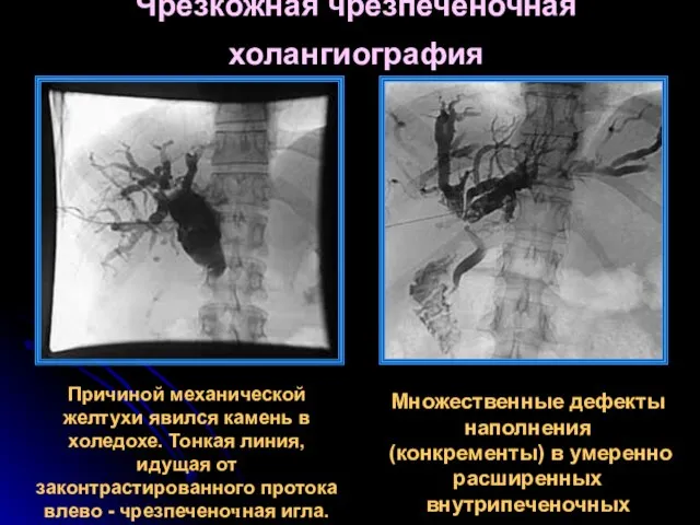 Чрезкожная чрезпеченочная холангиография Причиной механической желтухи явился камень в холедохе. Тонкая