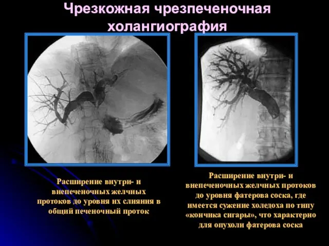 Чрезкожная чрезпеченочная холангиография Расширение внутри- и внепеченочных желчных протоков до уровня