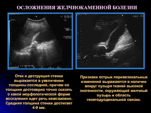 ОСЛОЖНЕНИЯ ЖЕЛЧНОКАМЕННОЙ БОЛЕЗНИ Отек и деструкция стенки выражается в увеличении толщины