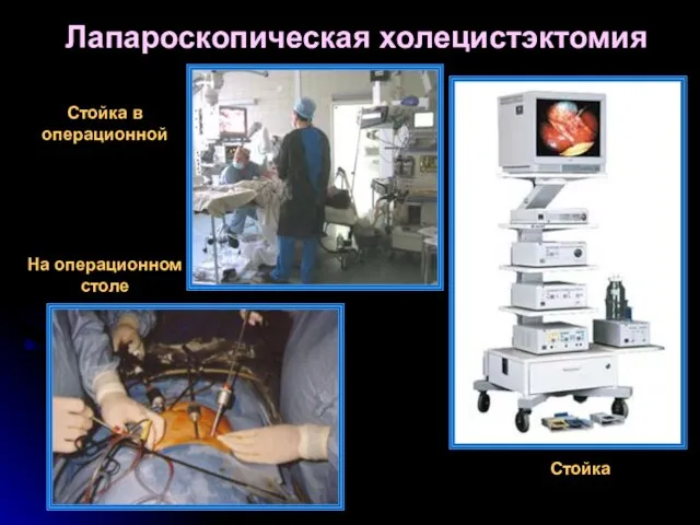 Лапароскопическая холецистэктомия Стойка в операционной На операционном столе Стойка