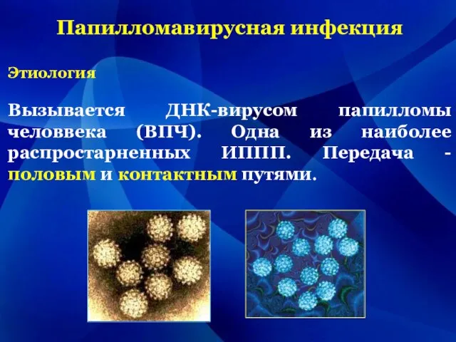 Папилломавирусная инфекция Этиология Вызывается ДНК-вирусом папилломы человвека (ВПЧ). Одна из наиболее